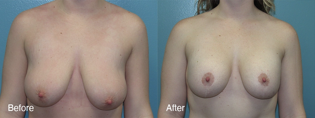Patient-1-2-Breast-Augmentation-w-Lift