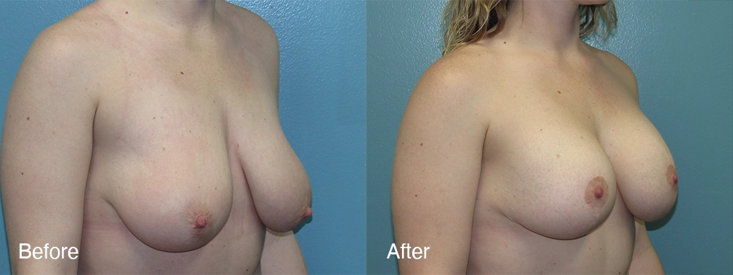 Patient-1-Breast-Augmentation-w-Lift