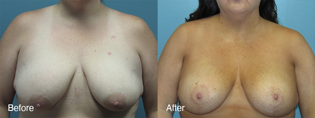 Patient-2-2-Breast-Augmentation-w-Lift