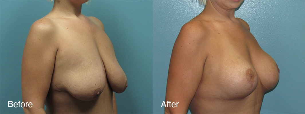 Patient-3-2-Breast-Augmentation-w-Lift