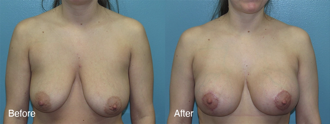 Patient-4-2-Breast-Augmentation-w-Lift