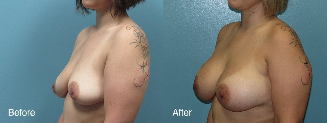 Patient-4-Breast-Augmentation