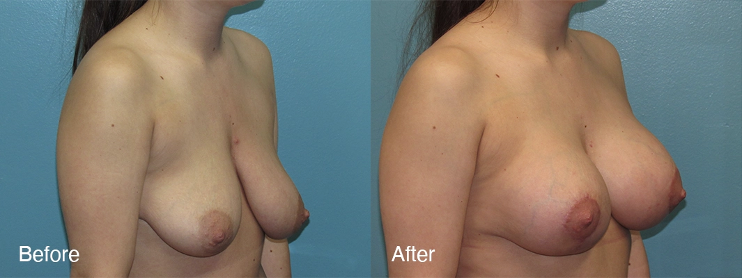 Patient-4-Breast-Augmentation-w-Lift