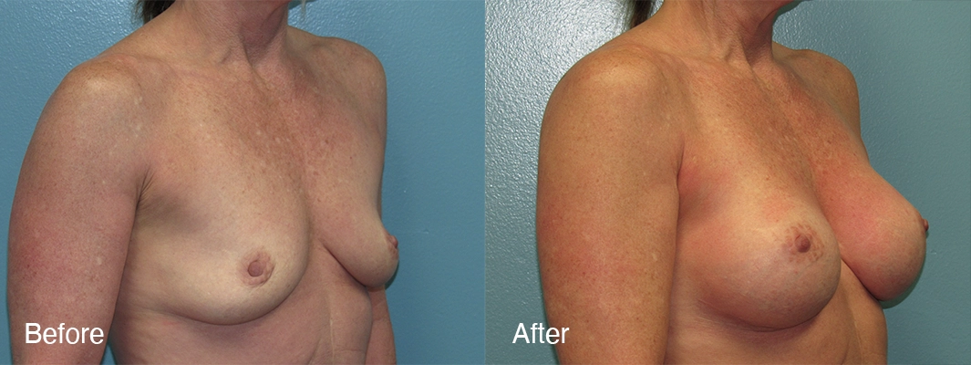 Patient-5-2-Breast-Augmentation