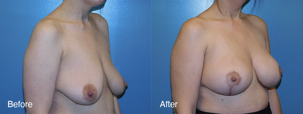 Patient-5-2-Breast-Augmentation-w-Lift