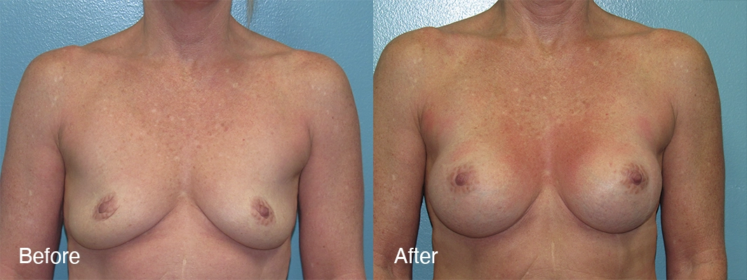 Patient-5-Breast-Augmentation