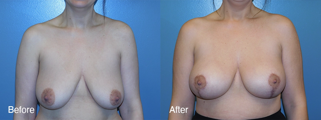 Patient-5-Breast-Augmentation-w-Lift