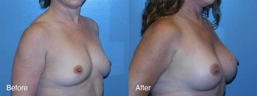 Patient-6-2-Breast-Augmentation