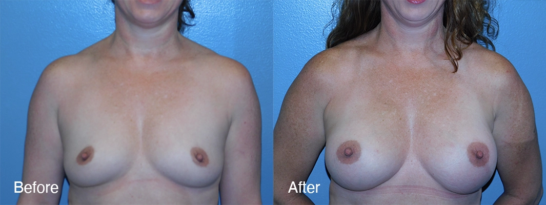 Patient-6-Breast-Augmentation