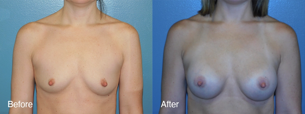 Patient-7-2-Breast-Augmentation