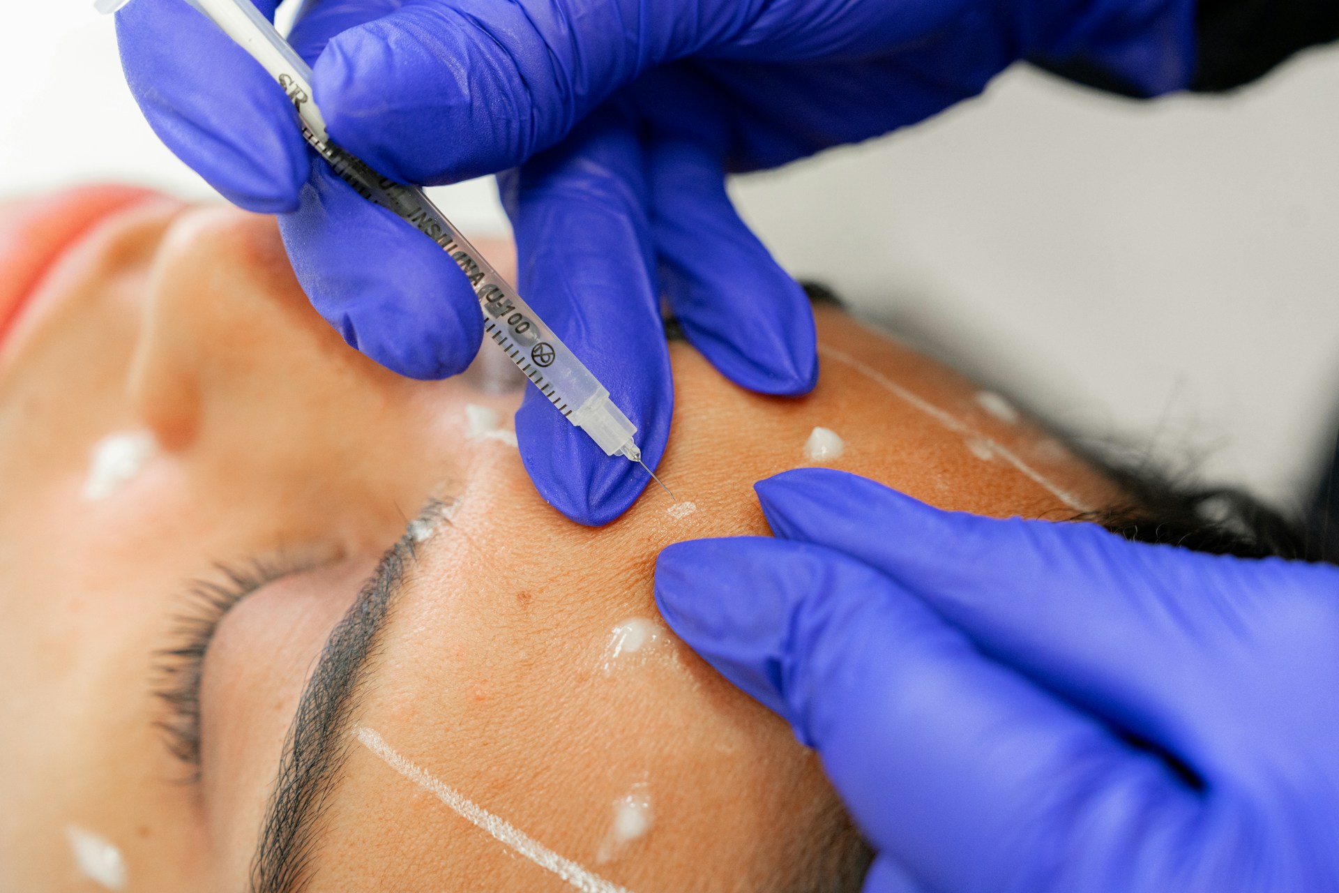 Patient receiving botox injections to soften forehead lines while maintaining natural facial movement.
