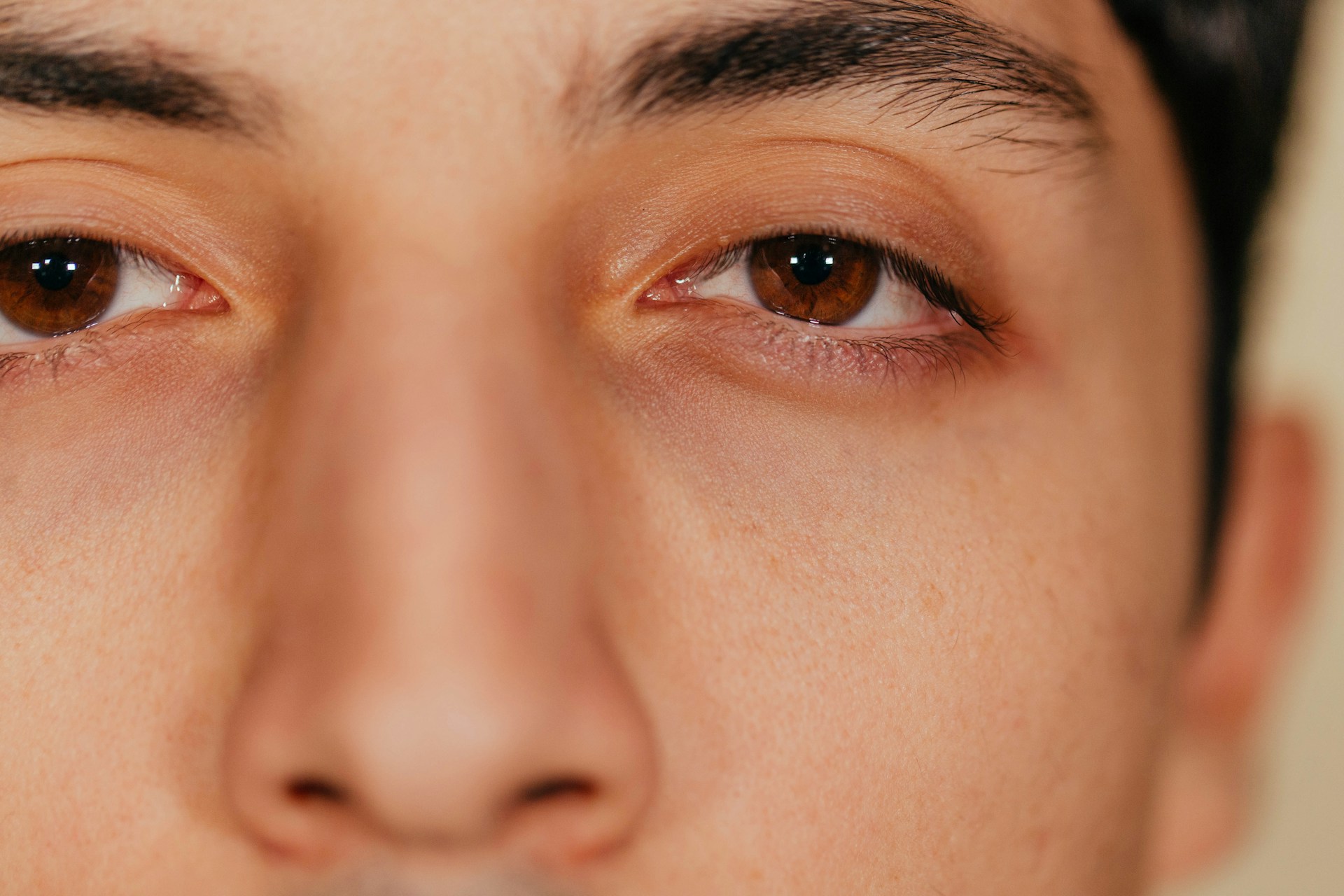 Close-up of a person’s eyes representing puffiness and recovery considerations after eyelid surgery.